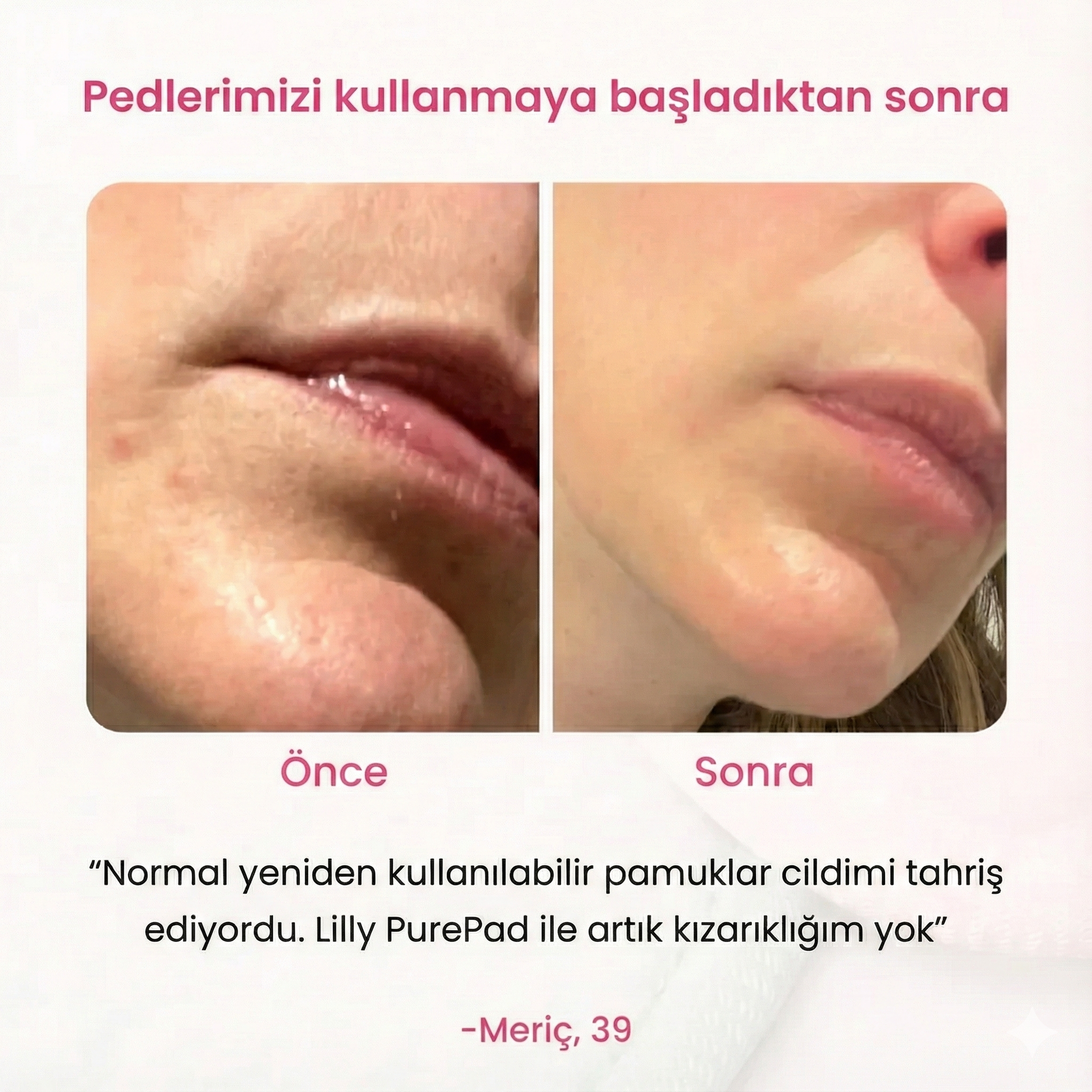Lilly PurePad öncesi ve sonrası cilt karşılaştırma görseli